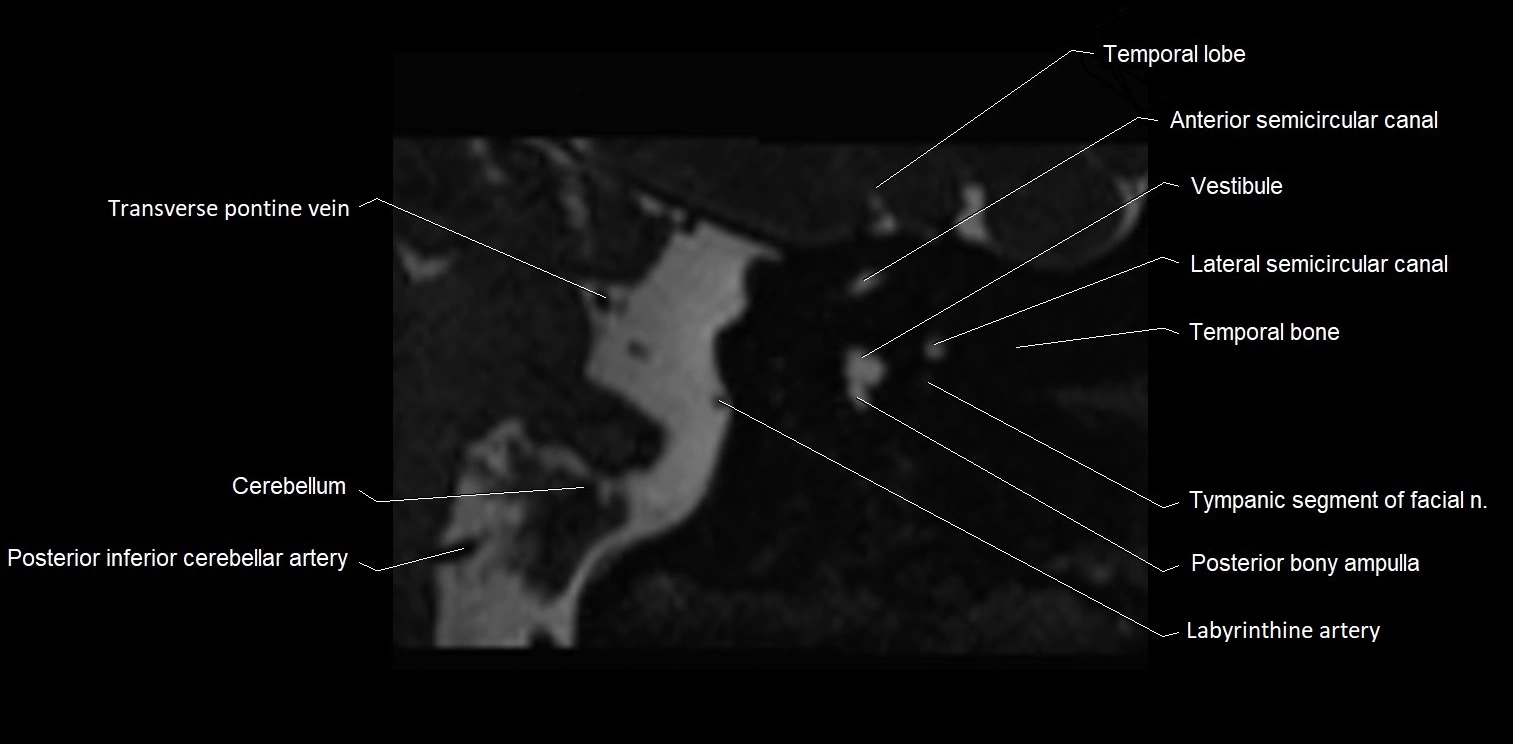 MRI Internal auditory meatus (IAM) coronal cross sectional labelled anatomy image 22.webp